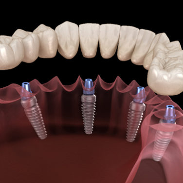 All-on-4 Dental Implants Arlington VA