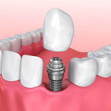 Single Tooth Implant Arlington VA